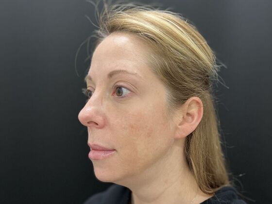 Injectables: Case 31 - Before