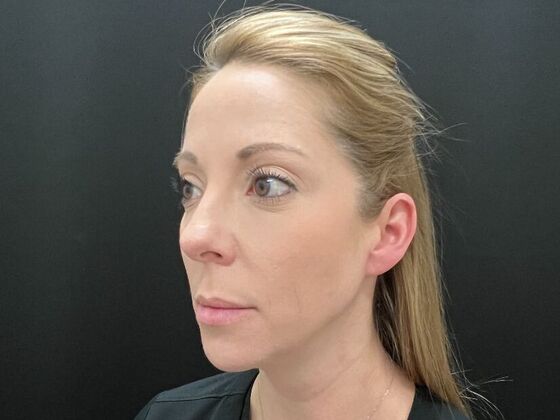 Injectables: Case 31 - After