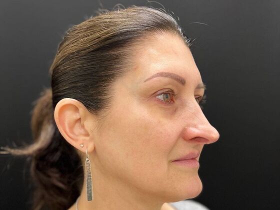 Injectables Case 32 - Before