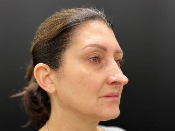 Injectables Case 32 - After