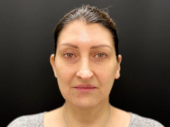 Injectables: Case 32 - After