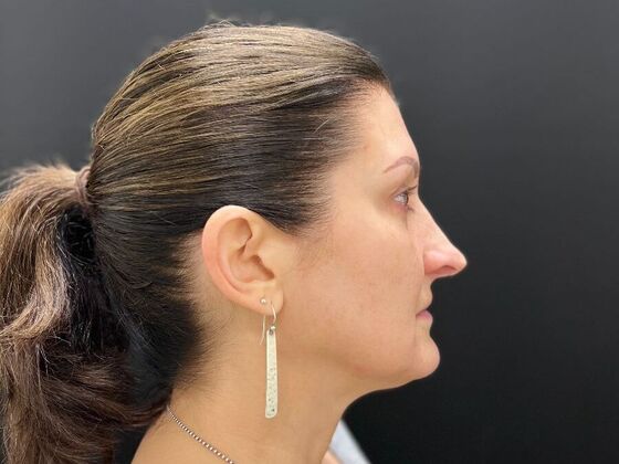 Injectables: Case 32 - Before