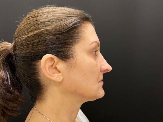 Injectables: Case 32 - After