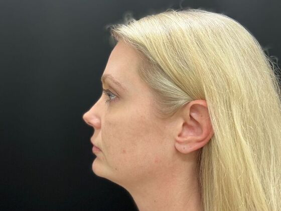 Injectables Case 33 - Before