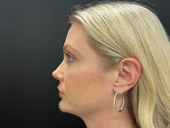 Injectables Case 33 - After