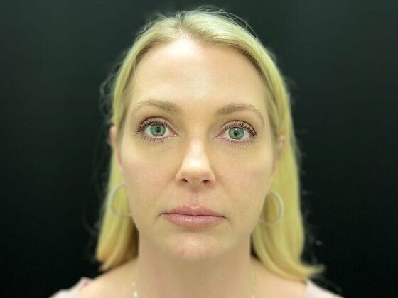 Injectables: Case 33 - Before