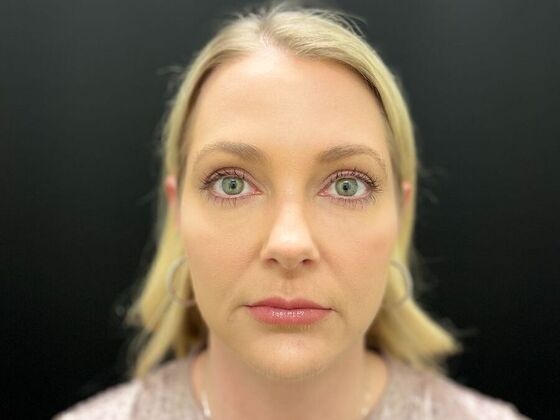 Injectables: Case 33 - After