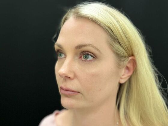 Injectables: Case 33 - Before