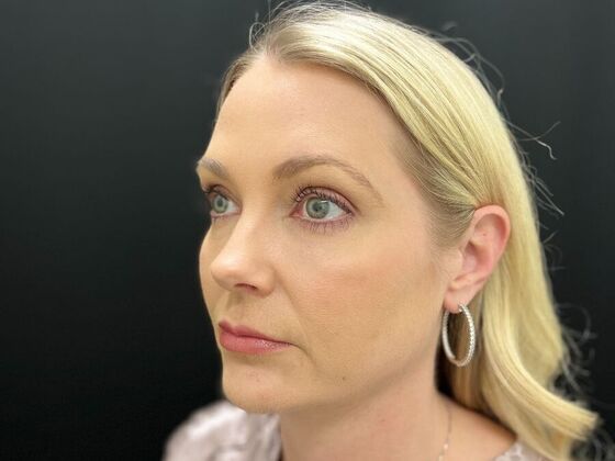 Injectables: Case 33 - After