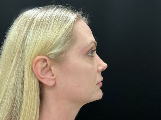 Injectables: Case 33 - Before