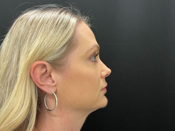 Injectables: Case 33 - After