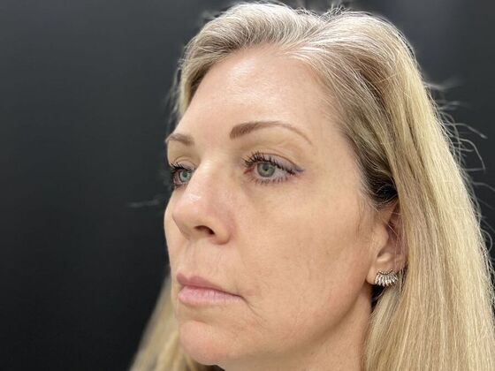 Injectables Case 34 - Before