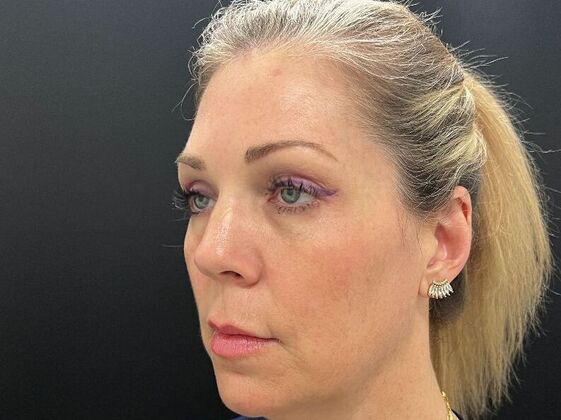 Injectables Case 34 - After