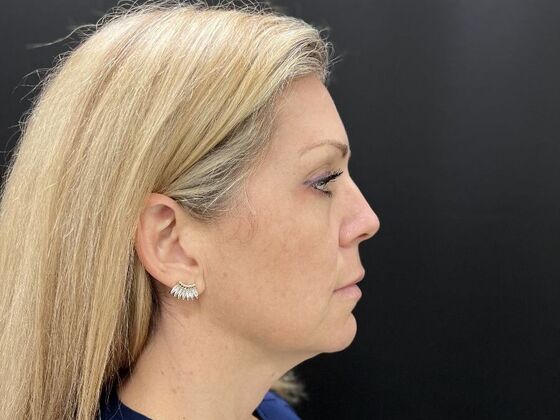 Injectables: Case 34 - Before