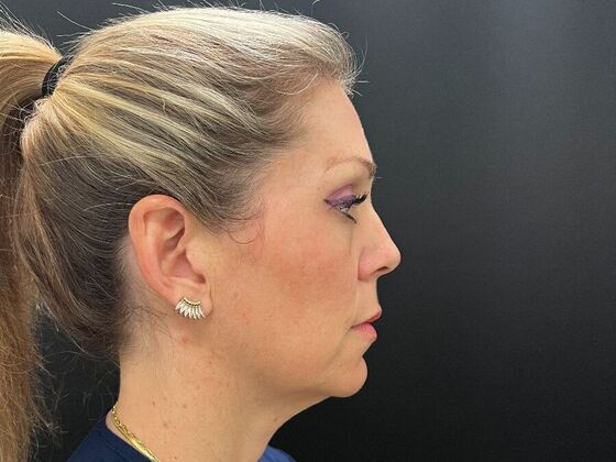 Injectables: Case 34 - After