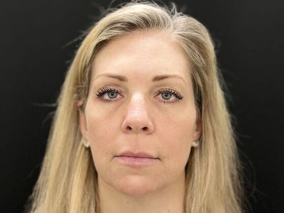 Injectables: Case 34 - Before