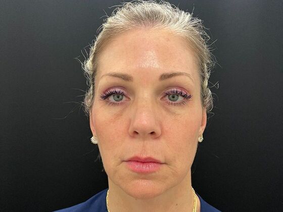 Injectables: Case 34 - After