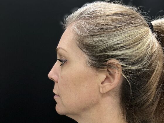 Injectables: Case 34 - Before