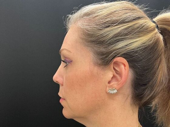 Injectables: Case 34 - After