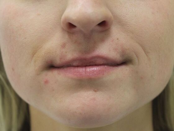 Injectables Case 35 - Before