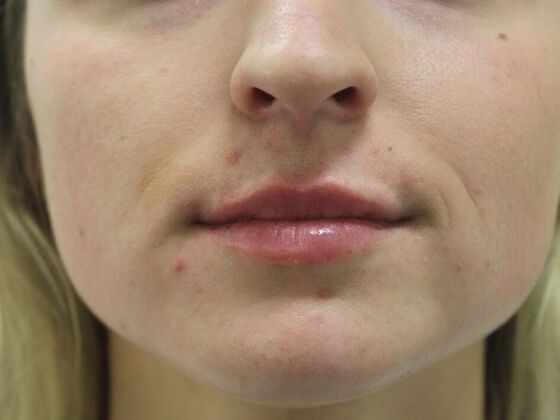 Injectables Case 35 - After