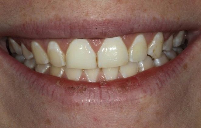 Veneers Case 2 - Before