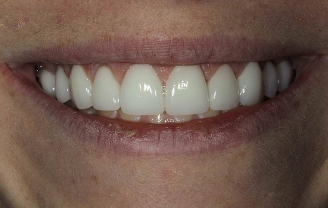 Veneers Case 2 - After