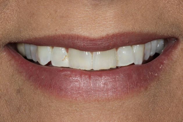 Veneers Case 3 - Before