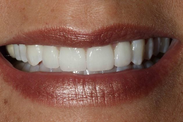 Veneers Case 3 - After