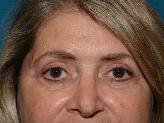 Eyelid Surgery: Case 6 - Carmel - After