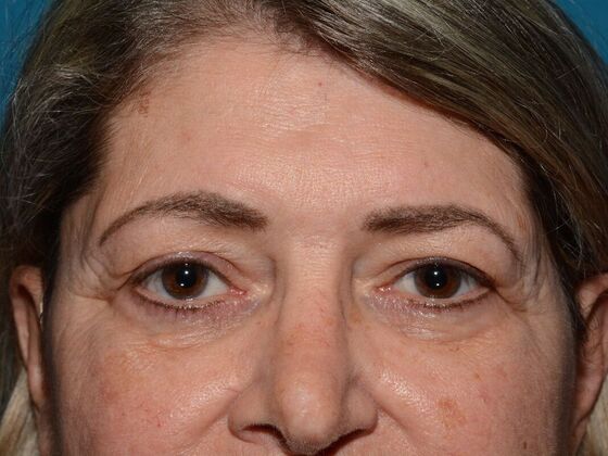 Eyelid Surgery: Case 6 - Carmel - Before