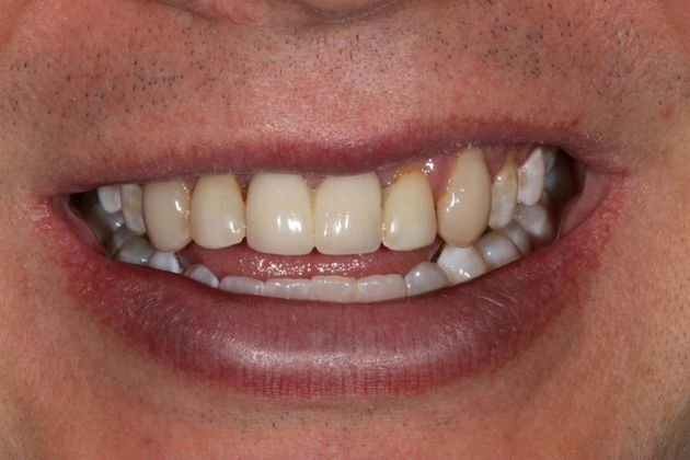 Dental Implants Case 1 - Before