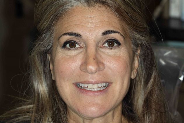 Smile Makeover Case 3 - Before