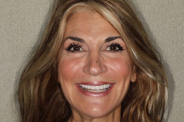 Smile Makeover Case 3 - After