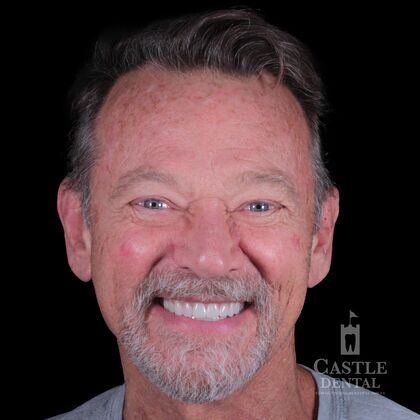 Full Mouth Restoration Cases