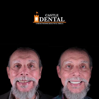 Full Mouth Restoration Cases