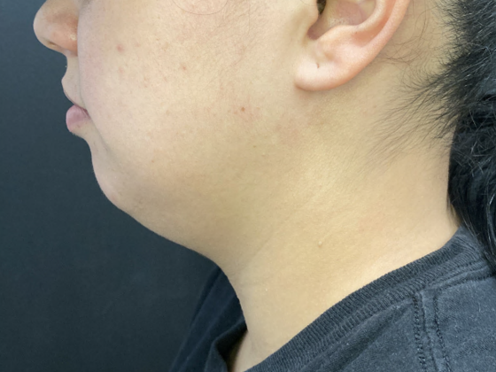 Coolsculpting Case 7 - Before