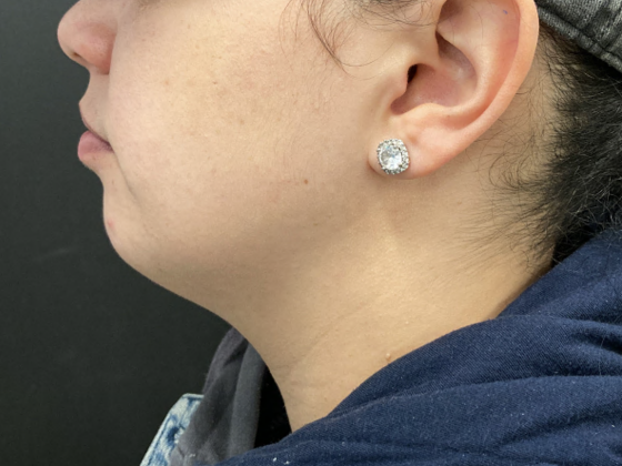 Coolsculpting Case 7 - After