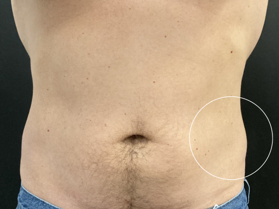 Coolsculpting Case 8 - Before