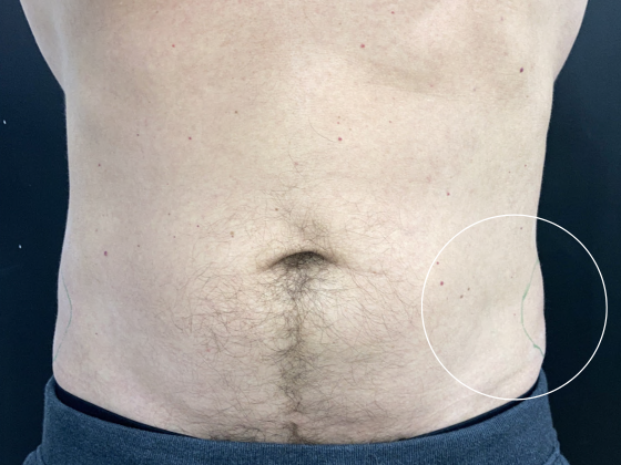 Coolsculpting Case 8 - After