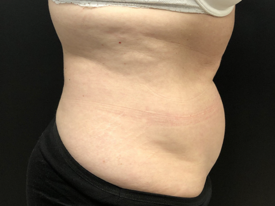 Coolsculpting Case 9 - Before