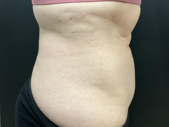 Coolsculpting Case 9 - After
