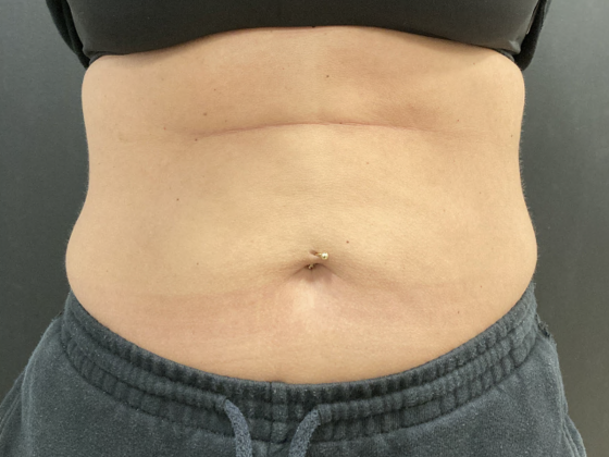 Coolsculpting Case 10 - Before