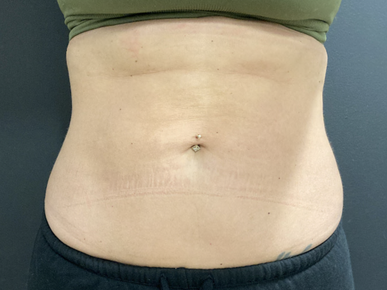 Coolsculpting Case 10 - After