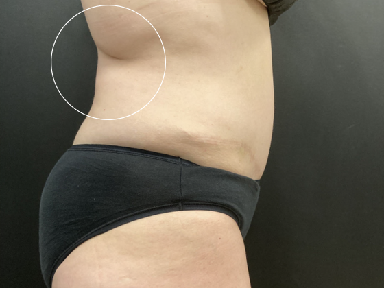 Coolsculpting Case 11 - Before