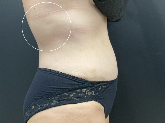 Coolsculpting Case 11 - After