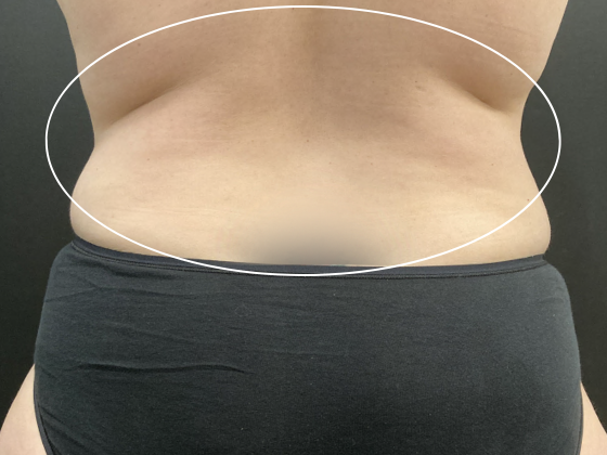 Coolsculpting: Case 11 - Before