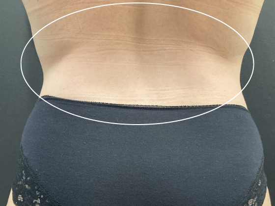 Coolsculpting: Case 11 - After