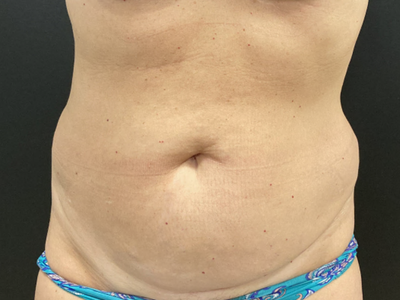 Coolsculpting Case 12 - Before