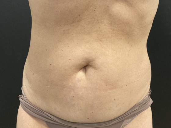 Coolsculpting Case 12 - After